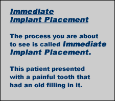 Implant Series - Dr. Guy Giacopuzzi, DDS, inventor of the Fancy Floss
